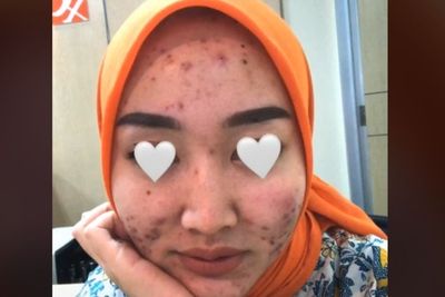 Viral Teller Bank Wajahnya Penuh Jerawat, Netizen Malah Curigai Ada Orang Dalam