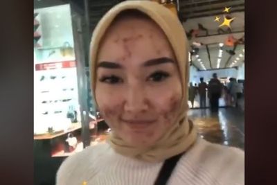 Teller Bank Wajahnya Penuh Jerawat, Tak Pernah Sekalipun Tutupi Kekurangannya, Salut!