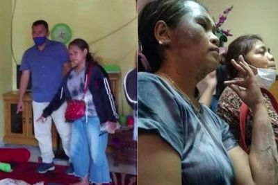 Cemburu Lihat Istrinya Main TikTok, Pria Ini Siramkan Air Keras, Tangan dan Wajah Melepuh