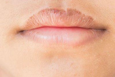 Sejumlah Fakta Tentang Bibir Pecah-pecah yang Harus Kamu Ketahui