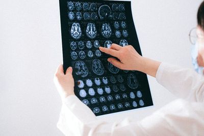 Ini Gejala Tumor Otak yang Harus Kamu Ketahui
