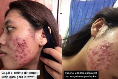 Pilu! Wanita Ini Gagal Dapat Kerja karena Jerawat di Wajah, Padahal Lolos Psikotest