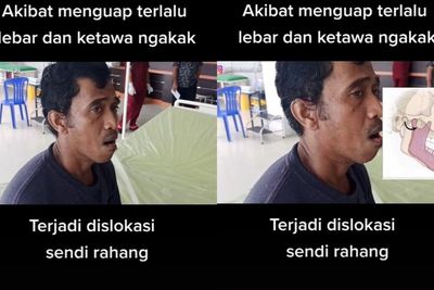 Akibat Menguap Terlalu Lebar, Rahang Pria Ini Bergeser dan Mulutnya Tak Bisa Tertutup