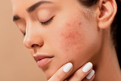 10 Cara Alami Menghilangkan Jerawat dengan Cepat