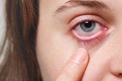 Mengenal Uveitis Radang Mata yang Bisa Sebabkan Kebutaan Jika Terlambat Ditangani