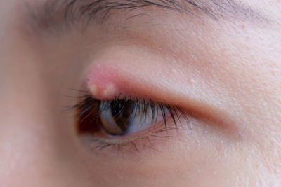 4 Cara Mudah Mengatasi Bintitan Pada Mata di Rumah