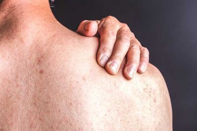 Jadi Penyebab Bintik Merah Pada Kulit, Ini Perbedaan Keratosis Pilaris dengan Psoriasis