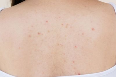 10 Cara Menghilangkan Jerawat di Punggung Tanpa Bekas, Ampuh!