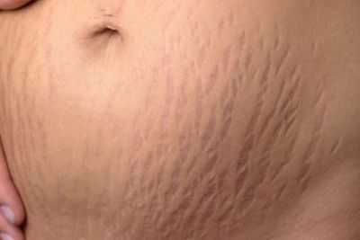 5 Bahan Alami yang Dapat Membantu Menghilangkan Stretch Mark di Badan