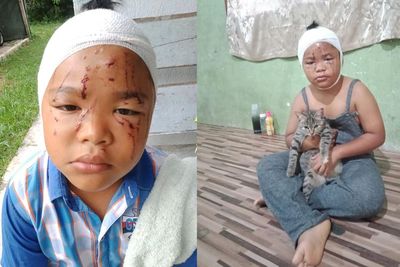 Bocah Ini Tetap Menyayangi Kucingnya, Meski Wajahnya Pernah Dicakar