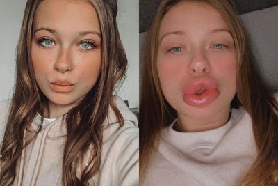 Bibir Wanita Ini Bengkak Setelah Lakukan Filler Bibir Murah