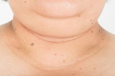 Tips Untuk Menghilangkan Double Chin yang Mudah Banget untuk Kamu Lakukan!