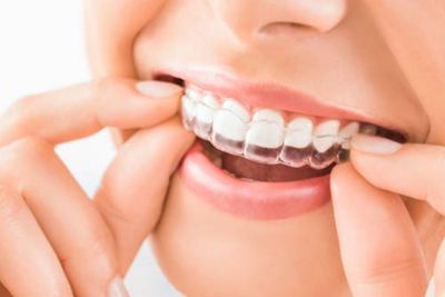 Inilah Cara Merapikan Gigi Selain Menggunakan Behel atau Kawat Gigi