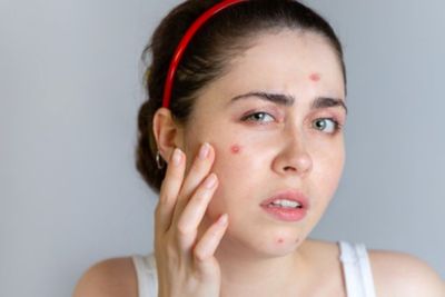 Kenali Jenis Jerawat Baru Cystic Acne dan Begini Cara Mengatasinya!