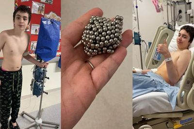 Berharap Jadi Magneto X-Men , Bocah Ini Telan 54 Butir Magnet, Hasilnya Ususnya Bocor