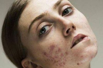 Untuk Atasi Flek Hitam Bekas Jerawat, Kamu Perlu Pakai Skincare dengan Kandungan Ini