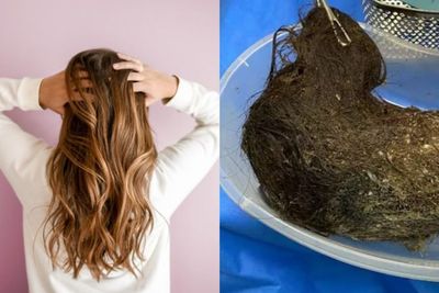 Alami Sindrom Rapunzel, Gadis Ini Makan Rambutnya Sendiri
