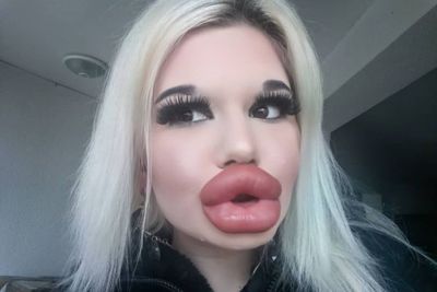 Pemilik Bibir Terbesar di Dunia Katakan Punya Payudara Besar Wanita Terlihat Lebih Feminin