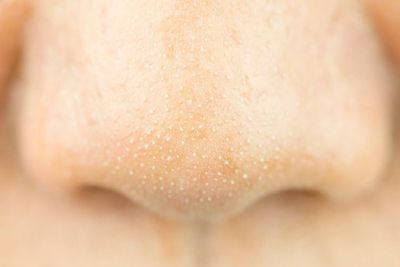 Sering Mengganggu, Ini Penyebab Munculnya Komedo Putih di Hidung