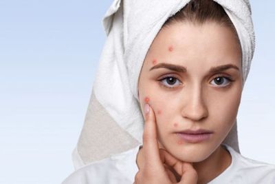 Ganti Skincare Buat Wajah Berjerawat, Purging atau Breakout?