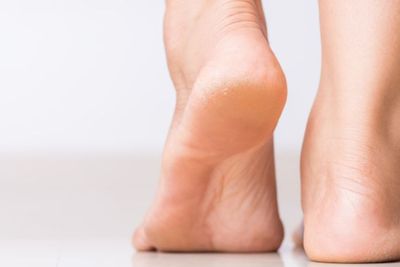 Segara Hindari, 4 Penyebab Kulit Kaki Kering dan Pecah-pecah