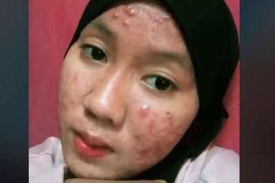 Viral Cewek Wajah Penuh Jerawat, Ternyata Diguna-guna Teman Dekat, Sudah Dianggap Saudara