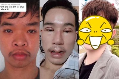Ditertawakan saat Wawancara Kerja, Pria Ini Jalani 9 Operasi Plastik hingga Jadi Tampan