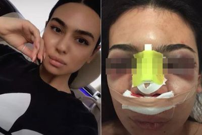 Operasi Hidung Gagal, Wanita Ini Hampir Meninggal karena Tengkoraknya Tertusuk