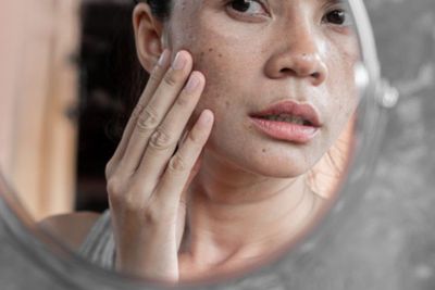 Penyebab Flek Hitam Muncul di Wajah, Salah Satunya Paparan Sinar UV