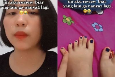 Wanita Ini Curi Perhatian karena Punya 24 Jari, Ternyata Idap Polidaktili