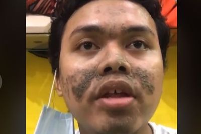 Cowok Wajahnya Rusak Gara-gara Krim, Sudah Bolak-balik ke Dokter hingga Ingin Bunuh Diri
