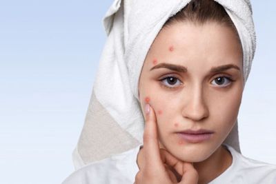 8 Tips Cara Mencegah Jerawat Muncul Kembali, Ini Rahasianya!