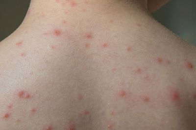 8 Cara Menghilangkan Bekas Cacar dengan Langkah Mudah, Ampuh!