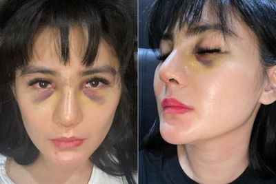 Potret Wajah Bengkak Angela Lee Usai Operasi Hidung Jadi Sorotan, Matanya Membiru