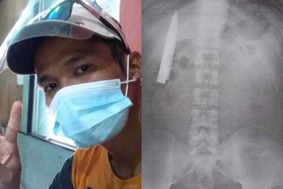 Pria Lakukan X-Ray untuk Lamaran Kerja, Malah Temukan Pisau Terjebak di Dadanya