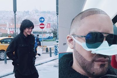 Penampilan Baru Kevin Aprilio Setelah Jalani Transplantasi Rambut