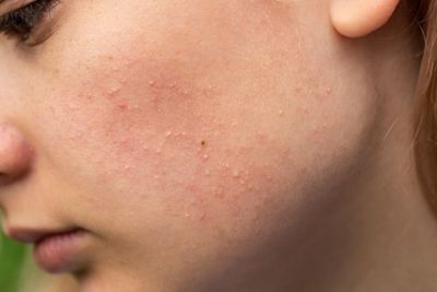 7 Cara Menghilangkan Bruntusan di Wajah dalam Waktu Singkat