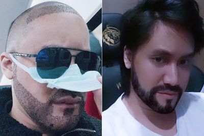 Kevin Aprilio Ungkap Transplantasi Rambut Jadi Kado Spesial di Ultah ke-31