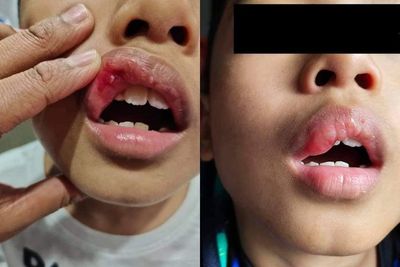 Siswa 7 Tahun Ini Ditampar Gurunya karena Menangis, Bibir Terluka dan Bengkak