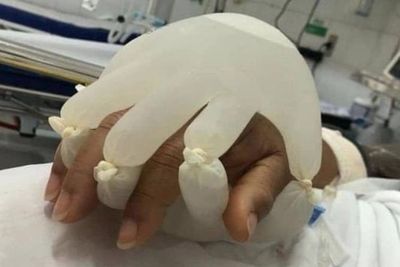 Viral, Pasien Covid-19 Ini Genggam 2 Sarung Tangan Karet Berisi Air untuk Dapat Kehangatan