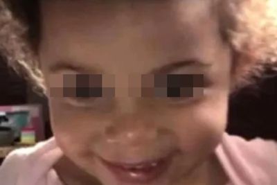 Kaki Gadis 2 Tahun Ini Harus Diamputasi Setelah Dapat Pelecehan dari Ayahnya Sendiri