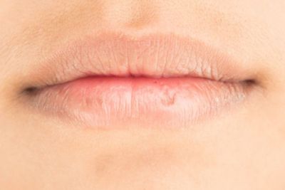 Cara Mengatasi Bibir Kering dan Pecah-Pecah Saat Puasa