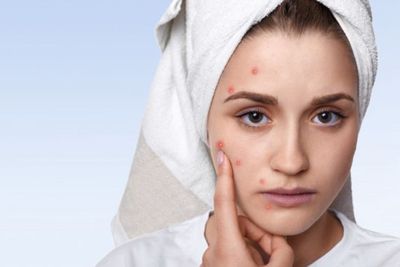 Mirip Jerawat, Begini Gejala Masalah Kulit Rosacea