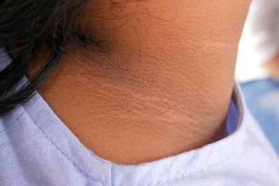 Cara Memutihkan Leher Hitam dan Belang dengan Bahan Alami