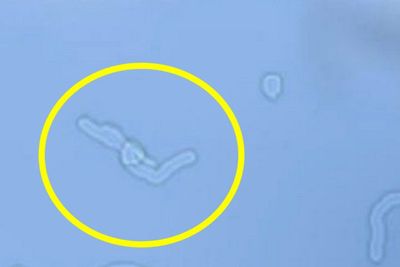 Fakta Eye Floaters, Bintik Kecil Seperti Cacing Melayang di Mata