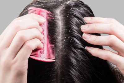 Apakah Ketombe Jadi Penyebab Rambut Rontok? Ini Kata Ahli Dermatologis