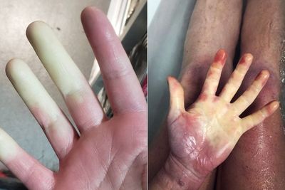 Sindrom Raynaud di Mana Penderitanya Mengalami Jari Memutih atau Biru untuk Sementara
