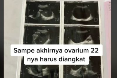 Tak Ada Keluhan, Wanita Ini Terkejut saat Cek, Ternyata Kista hingga Rahim Harus Diangkat