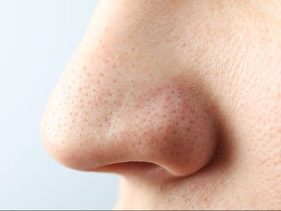 5 Cara Menghilangkan Komedo di Hidung Secara Permanen, Ampuh!