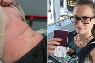 Alami Alergi Serius, Penyakit Wanita Ini Sembuh Setelah Liburan Keliling Dunia